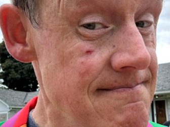 Joel Harden, a member of Canada's New Democratic Party, displays an abrasion on his face where he initially suggested he'd been punched during a demonstration.